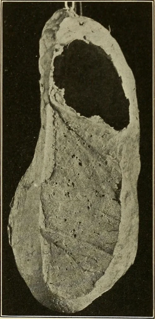 An illustration from The diseases of infancy and childhood : for the use of students and practitioners of medicine / by L. Emmett Holt and John Howland., 1911, leaf 1085