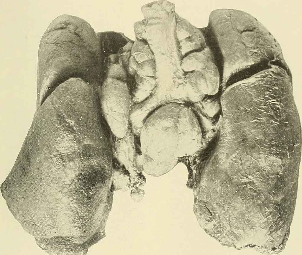 An illustration from The diseases of infancy and childhood : for the use of students and practitioners of medicine / by L. Emmett Holt and John Howland., 1911, leaf 1089