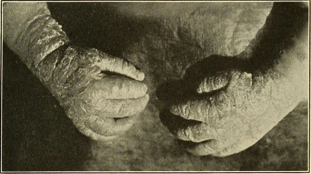 An illustration from The diseases of infancy and childhood : for the use of students and practitioners of medicine / by L. Emmett Holt and John Howland., 1911, leaf 1123