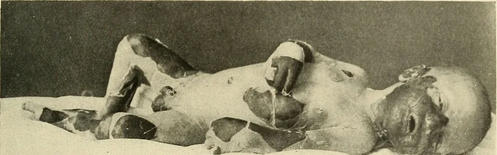 An illustration from The diseases of infancy and childhood : for the use of students and practitioners of medicine / by L. Emmett Holt and John Howland., 1911, leaf 119