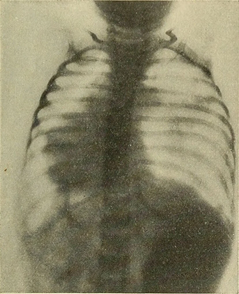 An illustration from The diseases of infancy and childhood : for the use of students and practitioners of medicine / by L. Emmett Holt and John Howland., 1911, leaf 143