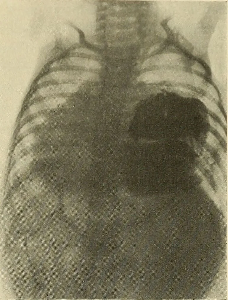 An illustration from The diseases of infancy and childhood : for the use of students and practitioners of medicine / by L. Emmett Holt and John Howland., 1911, leaf 143