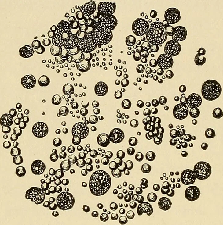 An illustration from The diseases of infancy and childhood : for the use of students and practitioners of medicine / by L. Emmett Holt and John Howland., 1911, leaf 156