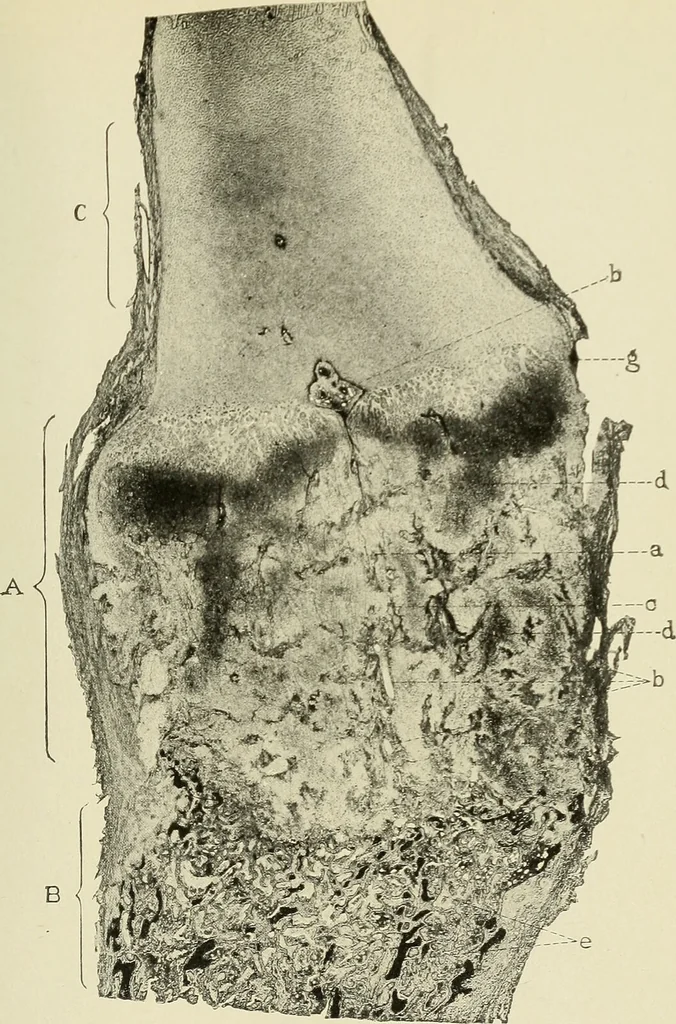 An illustration from The diseases of infancy and childhood : for the use of students and practitioners of medicine / by L. Emmett Holt and John Howland., 1911, leaf 277