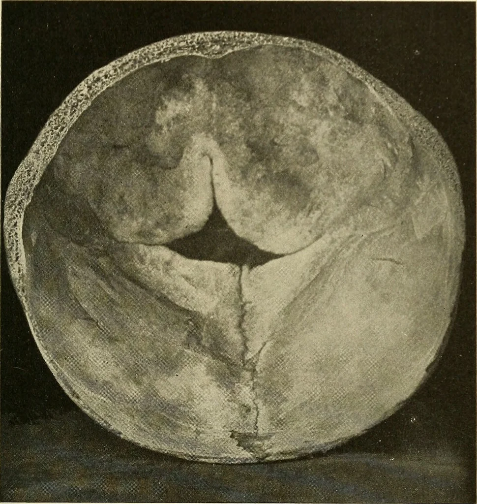 An illustration from The diseases of infancy and childhood : for the use of students and practitioners of medicine / by L. Emmett Holt and John Howland., 1911, leaf 283