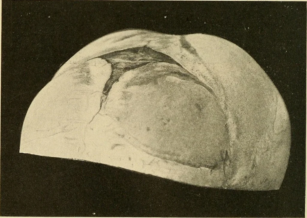 An illustration from The diseases of infancy and childhood : for the use of students and practitioners of medicine / by L. Emmett Holt and John Howland., 1911, leaf 284