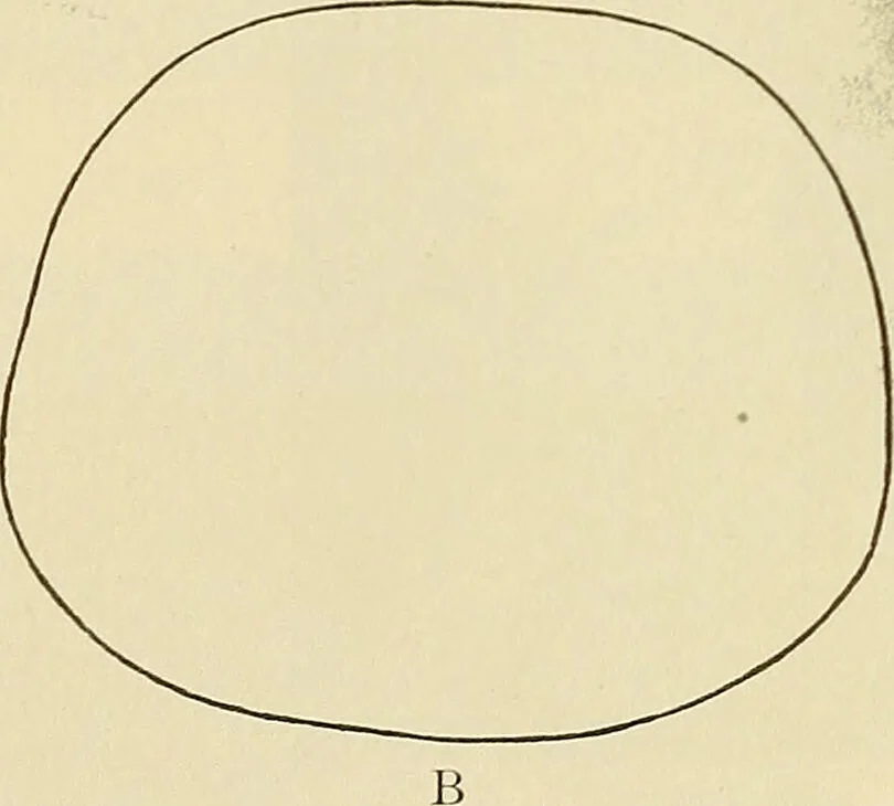 An illustration from The diseases of infancy and childhood : for the use of students and practitioners of medicine / by L. Emmett Holt and John Howland., 1911, leaf 285