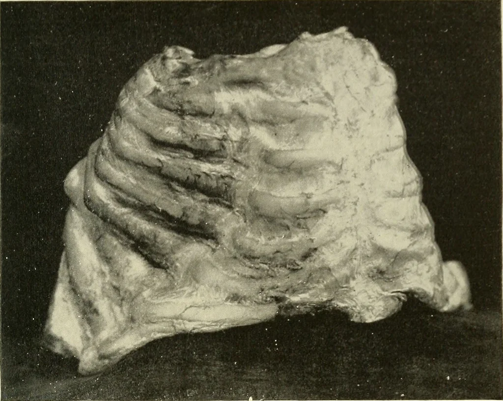 An illustration from The diseases of infancy and childhood : for the use of students and practitioners of medicine / by L. Emmett Holt and John Howland., 1911, leaf 287