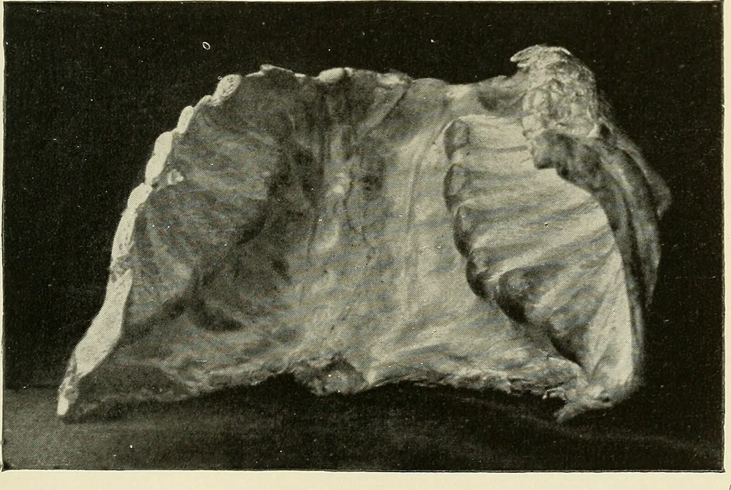 An illustration from The diseases of infancy and childhood : for the use of students and practitioners of medicine / by L. Emmett Holt and John Howland., 1911, leaf 287