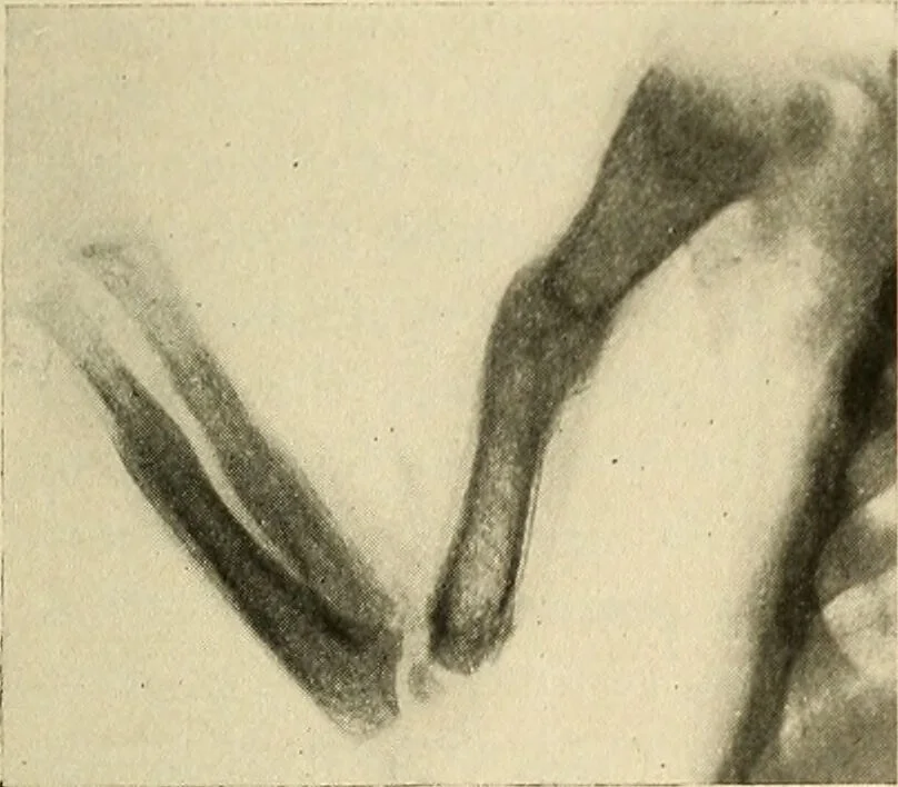 An illustration from The diseases of infancy and childhood : for the use of students and practitioners of medicine / by L. Emmett Holt and John Howland., 1911, leaf 289