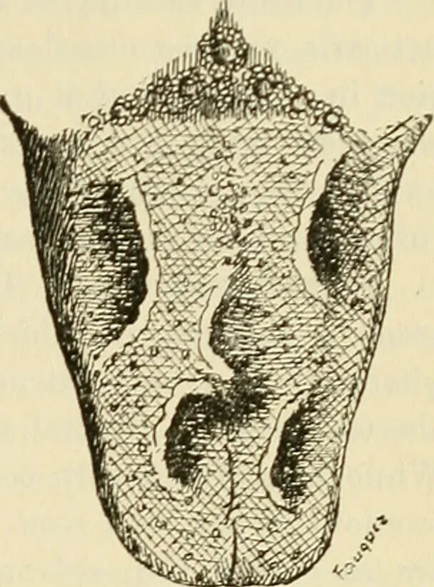 An illustration from The diseases of infancy and childhood : for the use of students and practitioners of medicine / by L. Emmett Holt and John Howland., 1911, leaf 301