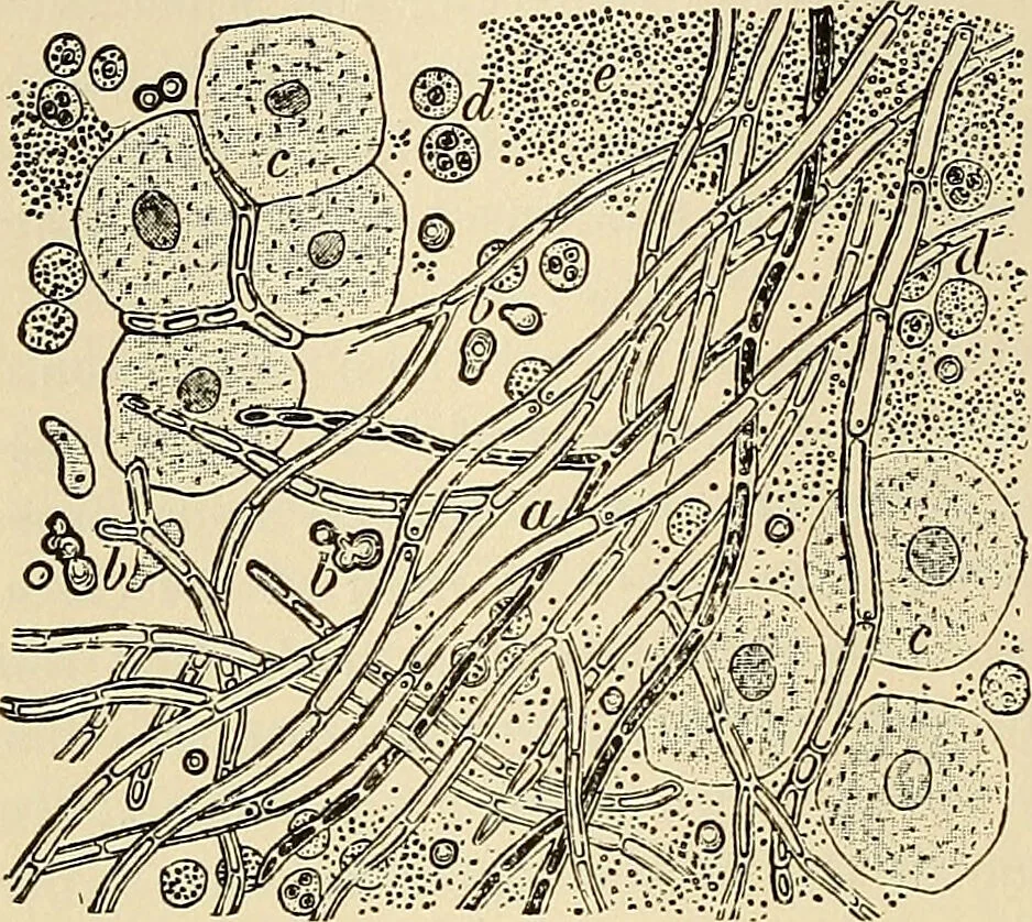 An illustration from The diseases of infancy and childhood : for the use of students and practitioners of medicine / by L. Emmett Holt and John Howland., 1911, leaf 312