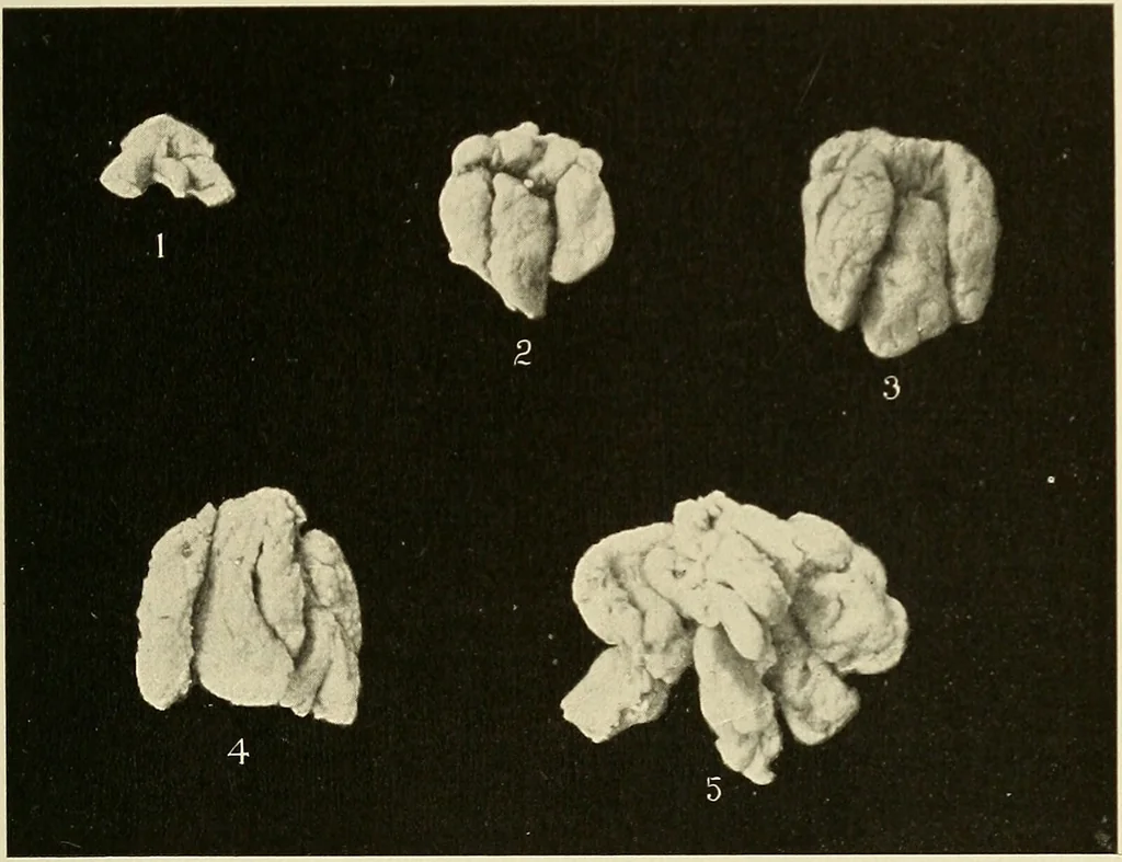 An illustration from The diseases of infancy and childhood : for the use of students and practitioners of medicine / by L. Emmett Holt and John Howland., 1911, leaf 325