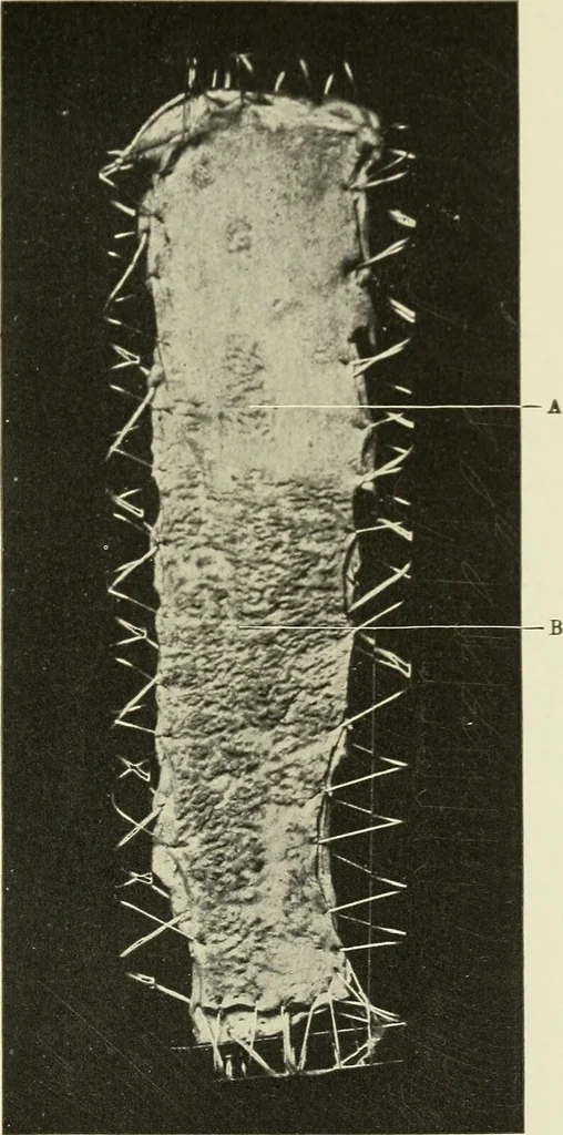 An illustration from The diseases of infancy and childhood : for the use of students and practitioners of medicine / by L. Emmett Holt and John Howland., 1911, leaf 415