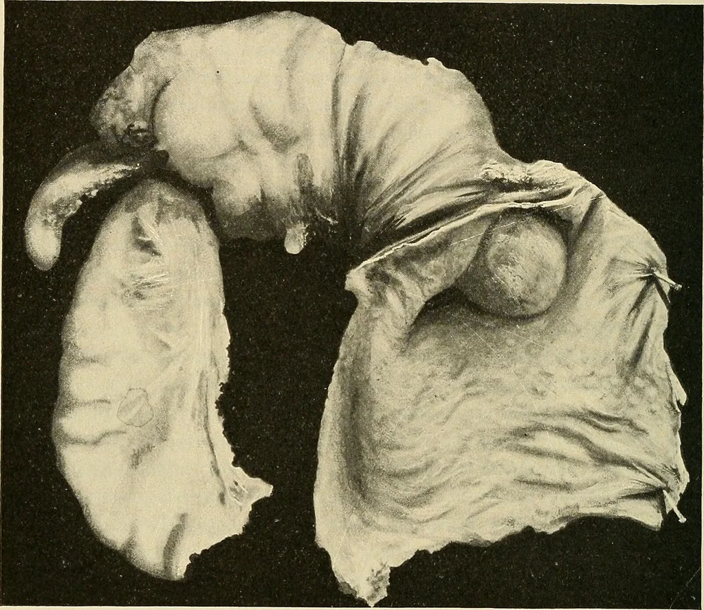 An illustration from The diseases of infancy and childhood : for the use of students and practitioners of medicine / by L. Emmett Holt and John Howland., 1911, leaf 452