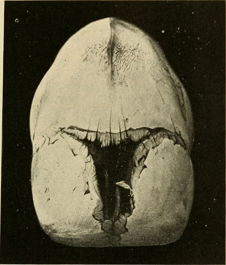 An illustration from The diseases of infancy and childhood : for the use of students and practitioners of medicine / by L. Emmett Holt and John Howland., 1911, leaf 47