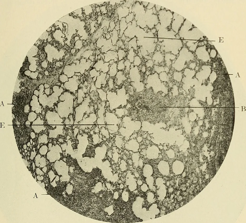 An illustration from The diseases of infancy and childhood : for the use of students and practitioners of medicine / by L. Emmett Holt and John Howland., 1911, leaf 543