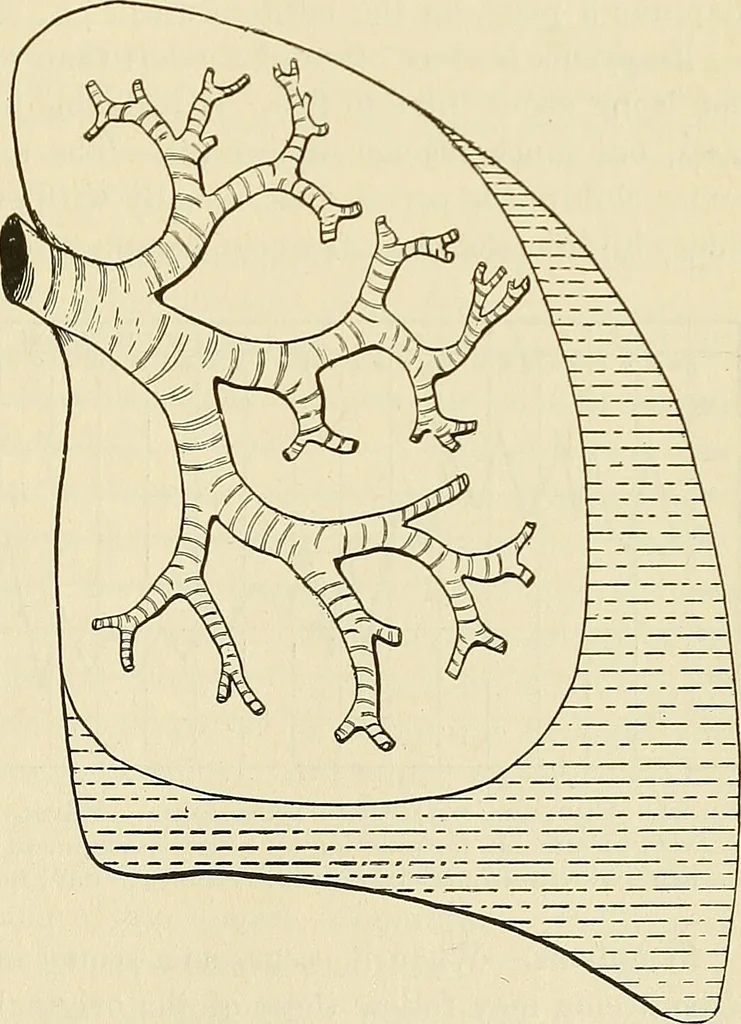 An illustration from The diseases of infancy and childhood : for the use of students and practitioners of medicine / by L. Emmett Holt and John Howland., 1911, leaf 605