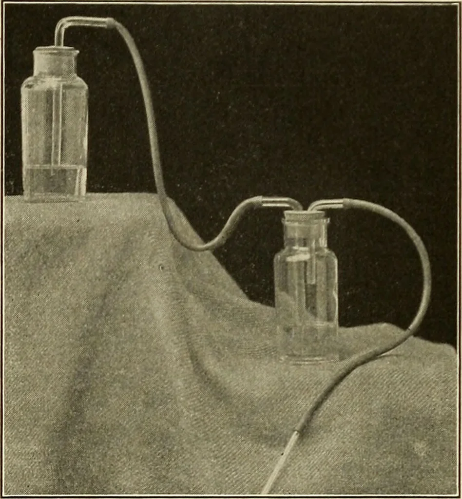 An illustration from The diseases of infancy and childhood : for the use of students and practitioners of medicine / by L. Emmett Holt and John Howland., 1911, leaf 613