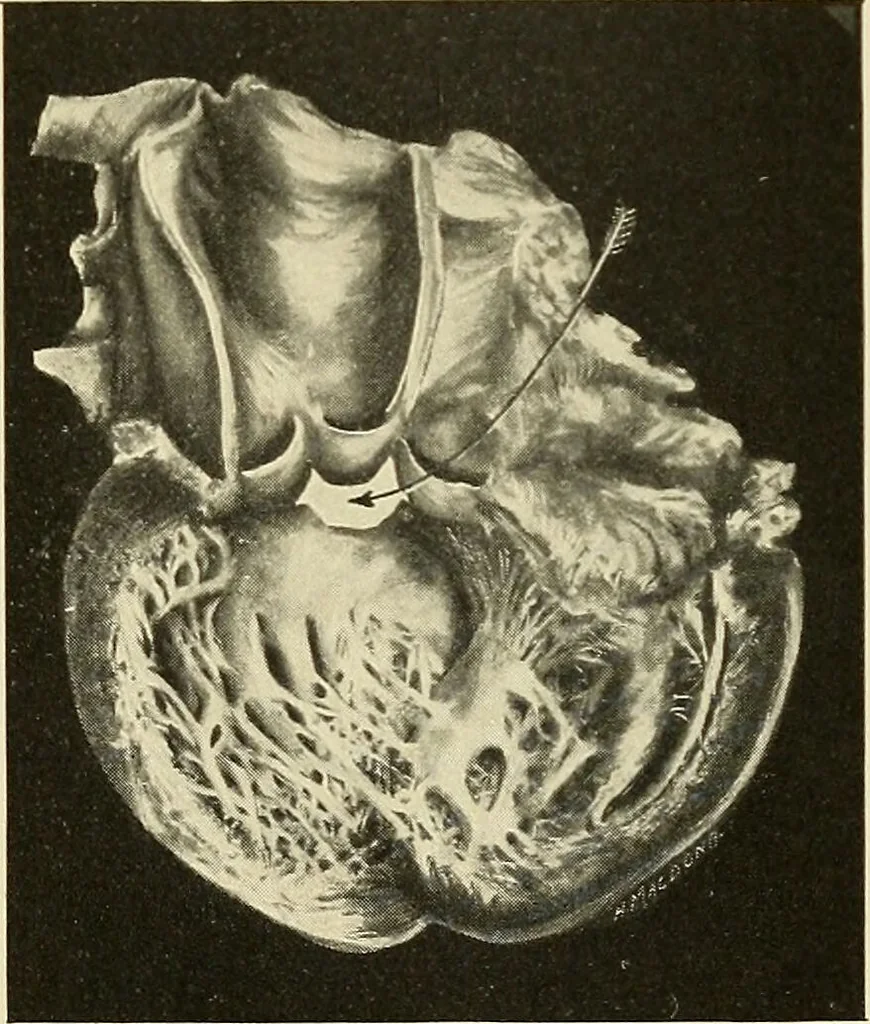 An illustration from The diseases of infancy and childhood : for the use of students and practitioners of medicine / by L. Emmett Holt and John Howland., 1911, leaf 619