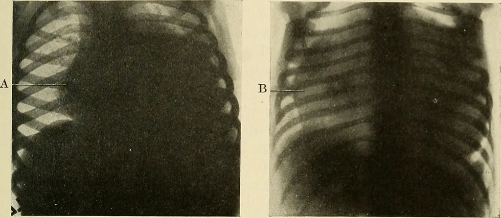 An illustration from The diseases of infancy and childhood : for the use of students and practitioners of medicine / by L. Emmett Holt and John Howland., 1911, leaf 629