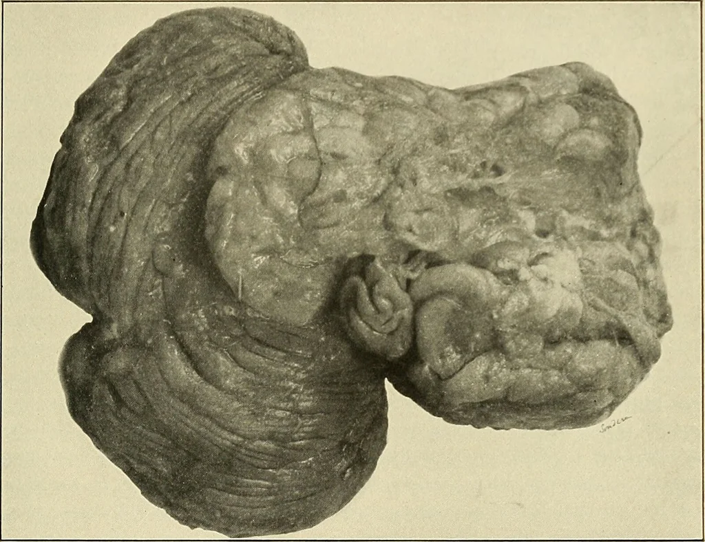 An illustration from The diseases of infancy and childhood : for the use of students and practitioners of medicine / by L. Emmett Holt and John Howland., 1911, leaf 793