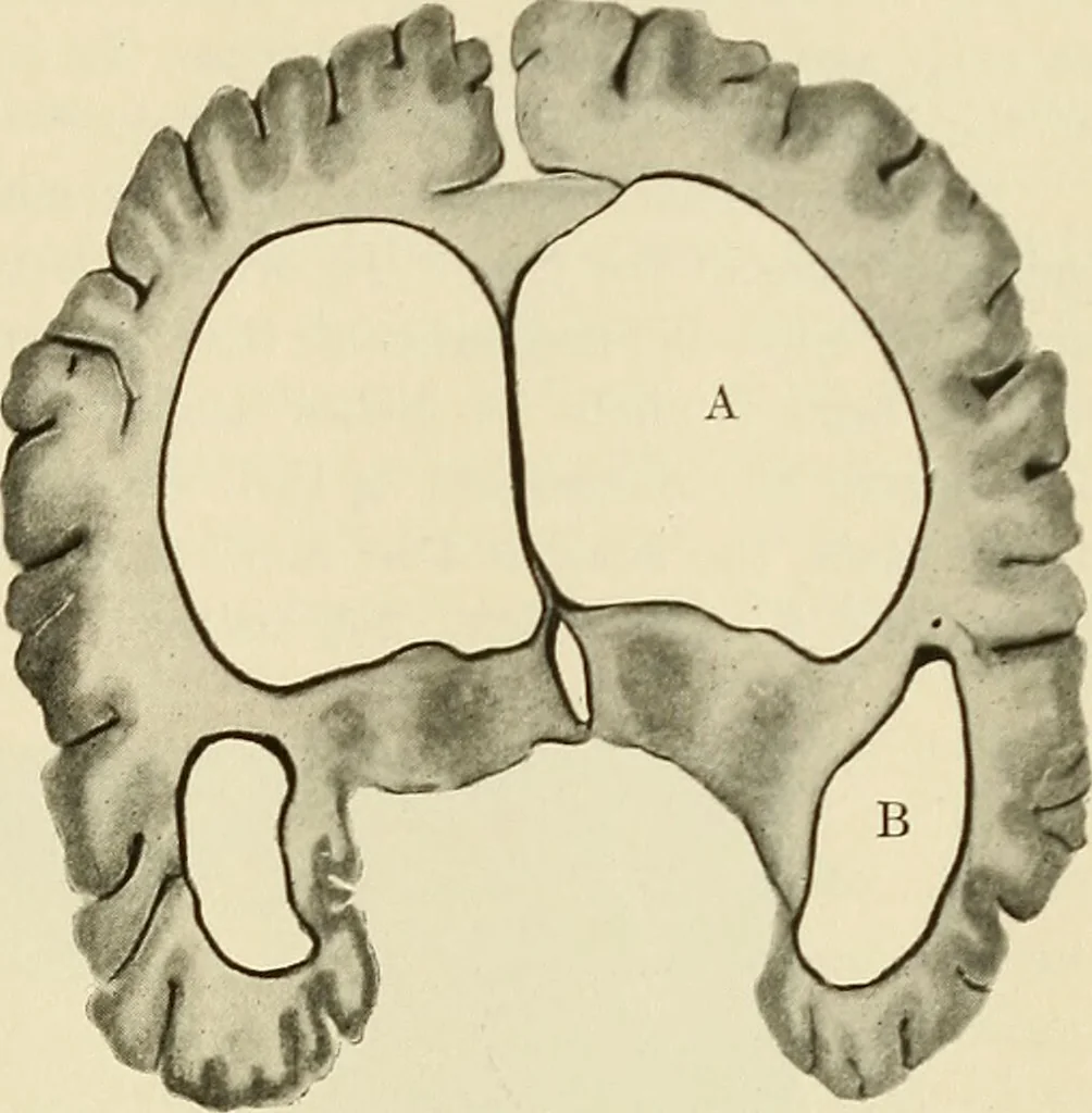 An illustration from The diseases of infancy and childhood : for the use of students and practitioners of medicine / by L. Emmett Holt and John Howland., 1911, leaf 795