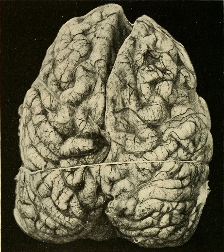 An illustration from The diseases of infancy and childhood : for the use of students and practitioners of medicine / by L. Emmett Holt and John Howland., 1911, leaf 810