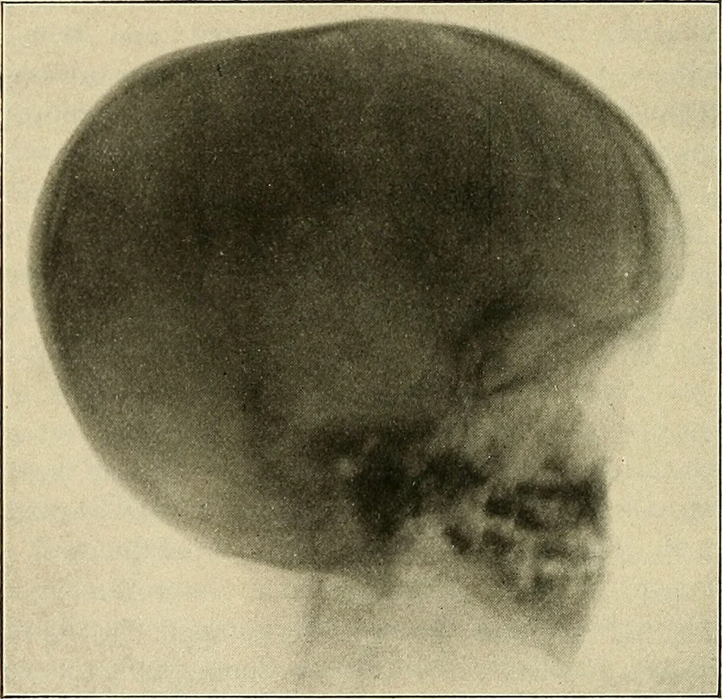 An illustration from The diseases of infancy and childhood : for the use of students and practitioners of medicine / by L. Emmett Holt and John Howland., 1911, leaf 814