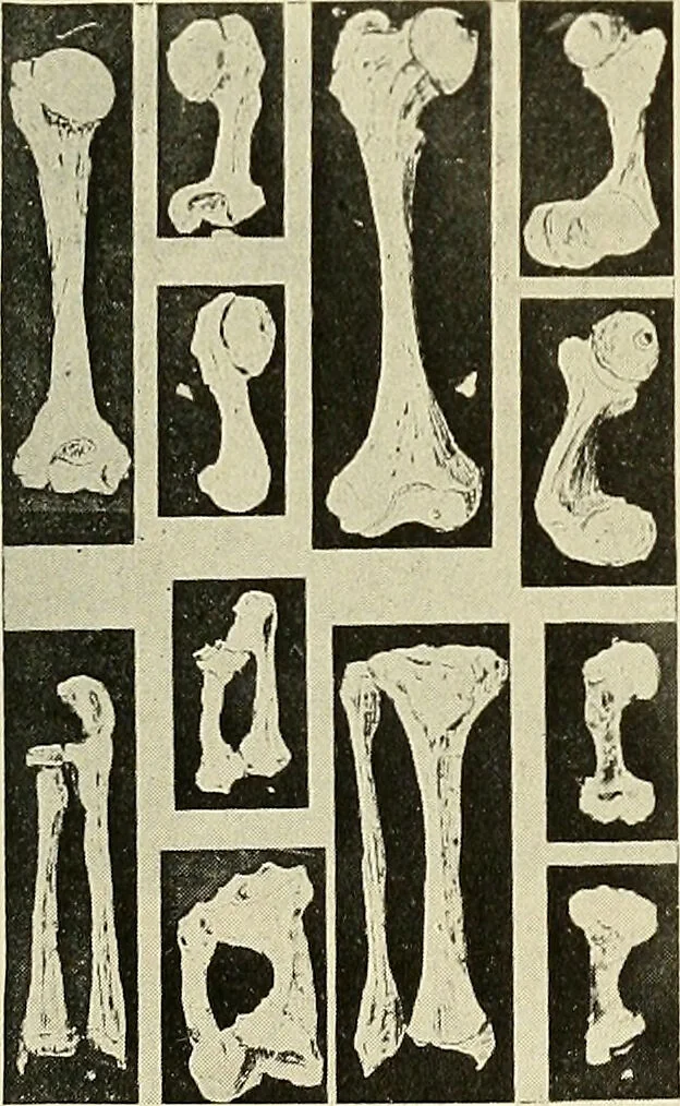 An illustration from The diseases of infancy and childhood : for the use of students and practitioners of medicine / by L. Emmett Holt and John Howland., 1911, leaf 815
