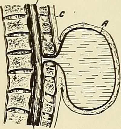 An illustration from The diseases of infancy and childhood : for the use of students and practitioners of medicine / by L. Emmett Holt and John Howland., 1911, leaf 825