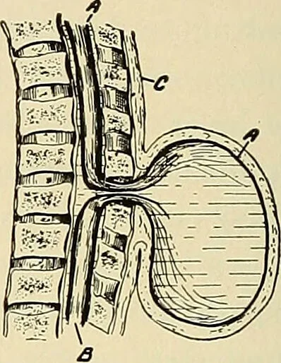 An illustration from The diseases of infancy and childhood : for the use of students and practitioners of medicine / by L. Emmett Holt and John Howland., 1911, leaf 826