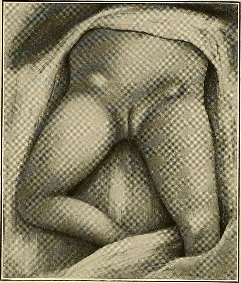 An illustration from The diseases of infancy and childhood : for the use of students and practitioners of medicine / by L. Emmett Holt and John Howland., 1911, leaf 892