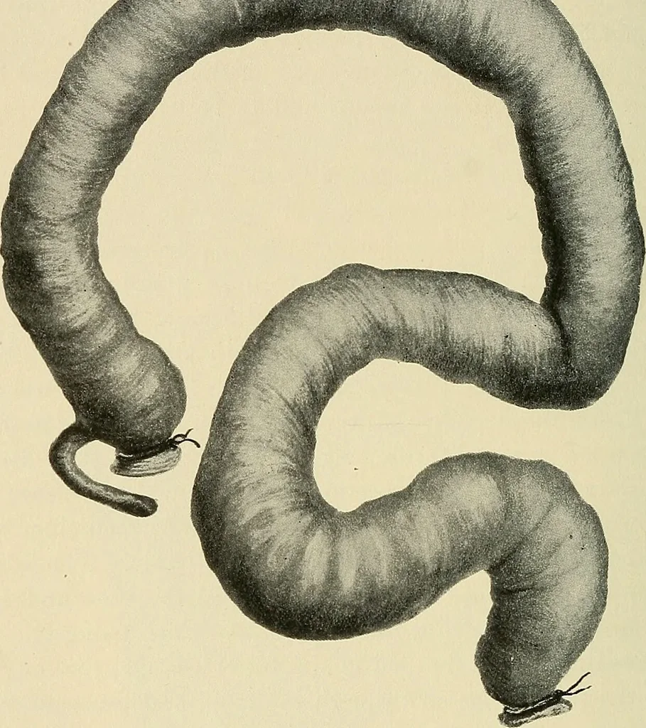 An illustration from The diseases of infancy and childhood : for the use of students and practitioners of medicine / by L. Emmett Holt and John Howland., 1911, leaf 90