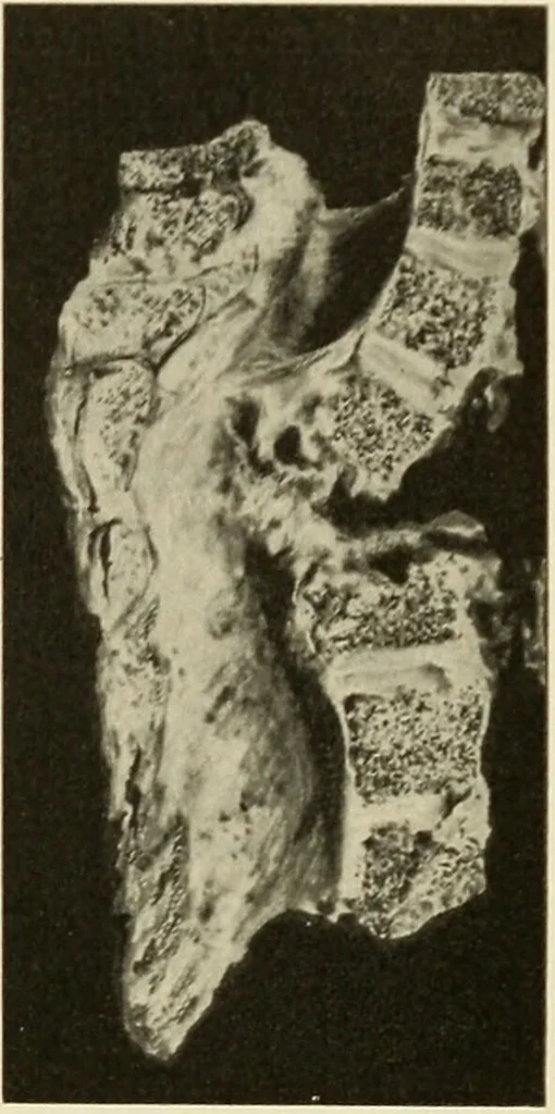 An illustration from The diseases of infancy and childhood : for the use of students and practitioners of medicine / by L. Emmett Holt and John Howland., 1911, leaf 909