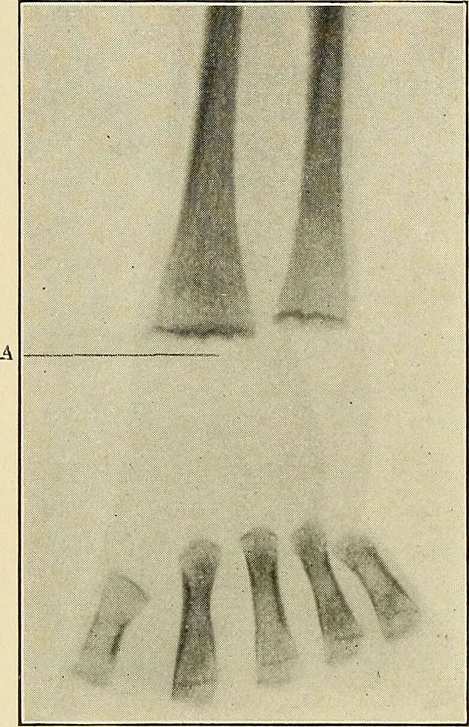 An illustration from The diseases of infancy and childhood : for the use of students and practitioners of medicine / by L. Emmett Holt and John Howland., 1911, leaf 922