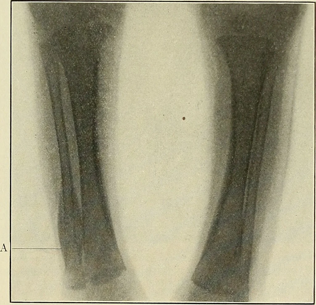 An illustration from The diseases of infancy and childhood : for the use of students and practitioners of medicine / by L. Emmett Holt and John Howland., 1911, leaf 923