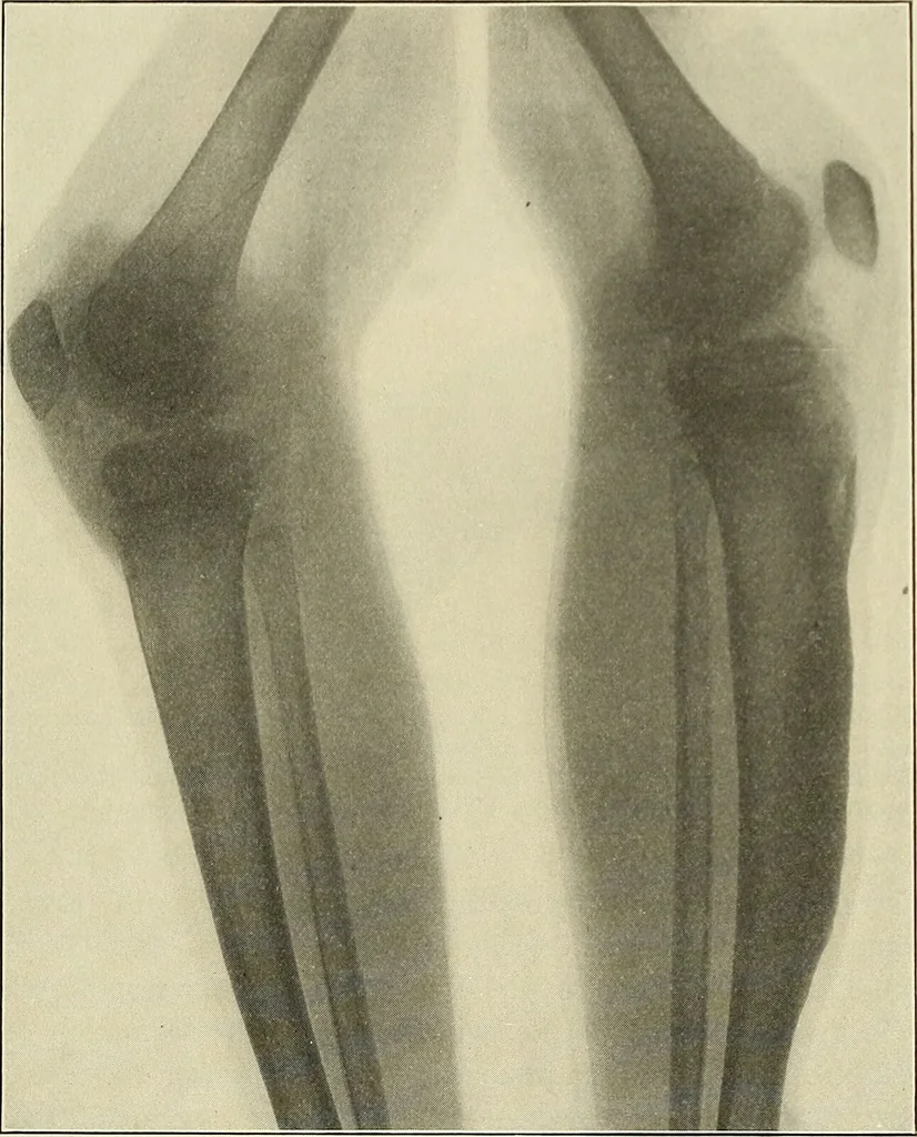 An illustration from The diseases of infancy and childhood : for the use of students and practitioners of medicine / by L. Emmett Holt and John Howland., 1911, leaf 925