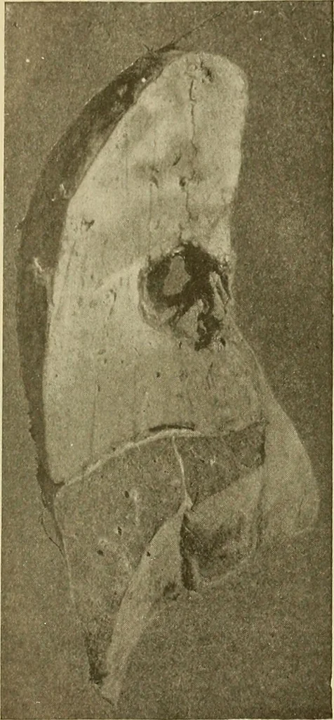 An illustration from The diseases of infancy and childhood : for the use of students and practitioners of medicine / by L. Emmett Holt with two hundred and forty-one illustrations, including eight coloured plates., 1908, leaf 1129