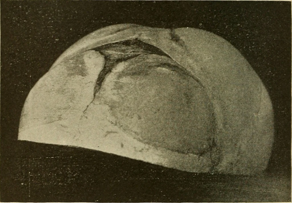 An illustration from The diseases of infancy and childhood : for the use of students and practitioners of medicine / by L. Emmett Holt with two hundred and forty-one illustrations, including eight coloured plates., 1908, leaf 294