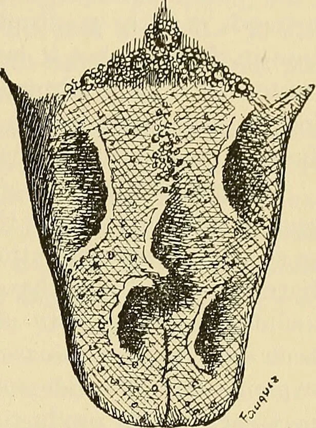 An illustration from The diseases of infancy and childhood : for the use of students and practitioners of medicine / by L. Emmett Holt with two hundred and forty-one illustrations, including eight coloured plates., 1908, leaf 309