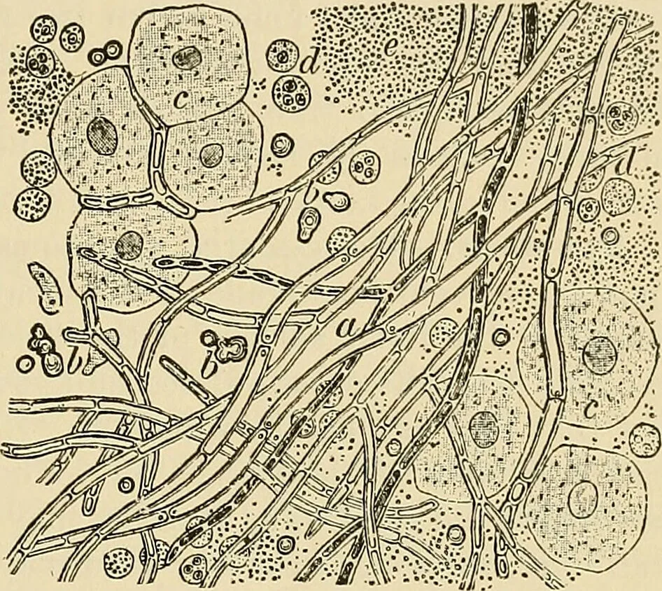 An illustration from The diseases of infancy and childhood : for the use of students and practitioners of medicine / by L. Emmett Holt with two hundred and forty-one illustrations, including eight coloured plates., 1908, leaf 319