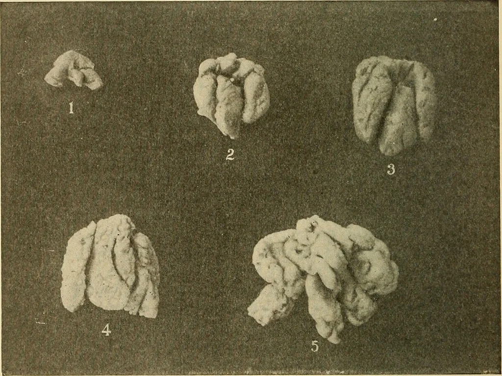 An illustration from The diseases of infancy and childhood : for the use of students and practitioners of medicine / by L. Emmett Holt with two hundred and forty-one illustrations, including eight coloured plates., 1908, leaf 332