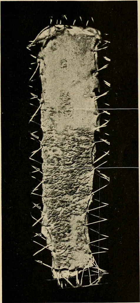 An illustration from The diseases of infancy and childhood : for the use of students and practitioners of medicine / by L. Emmett Holt with two hundred and forty-one illustrations, including eight coloured plates., 1908, leaf 429