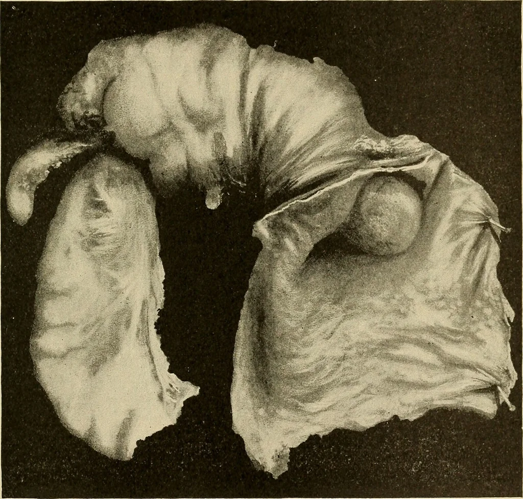 An illustration from The diseases of infancy and childhood : for the use of students and practitioners of medicine / by L. Emmett Holt with two hundred and forty-one illustrations, including eight coloured plates., 1908, leaf 467