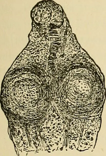 An illustration from The diseases of infancy and childhood : for the use of students and practitioners of medicine / by L. Emmett Holt with two hundred and forty-one illustrations, including eight coloured plates., 1908, leaf 485