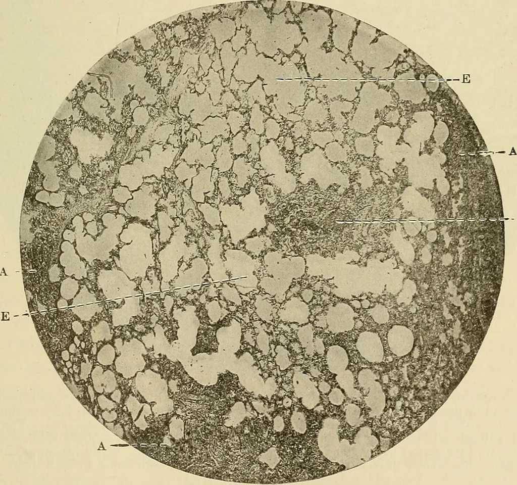 An illustration from The diseases of infancy and childhood : for the use of students and practitioners of medicine / by L. Emmett Holt with two hundred and forty-one illustrations, including eight coloured plates., 1908, leaf 577