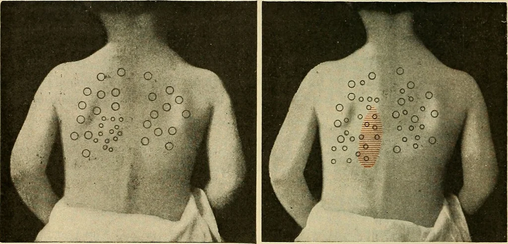 An illustration from The diseases of infancy and childhood : for the use of students and practitioners of medicine / by L. Emmett Holt with two hundred and forty-one illustrations, including eight coloured plates., 1908, leaf 586