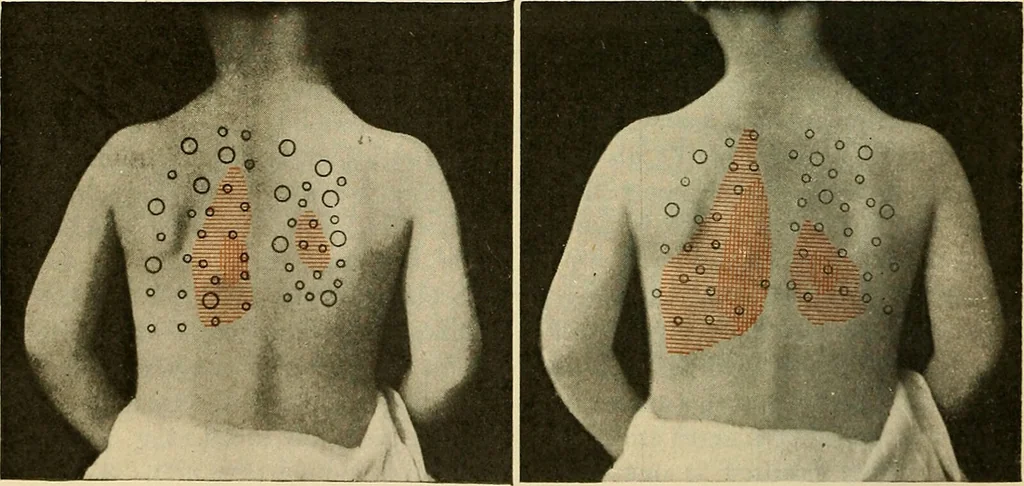 An illustration from The diseases of infancy and childhood : for the use of students and practitioners of medicine / by L. Emmett Holt with two hundred and forty-one illustrations, including eight coloured plates., 1908, leaf 586