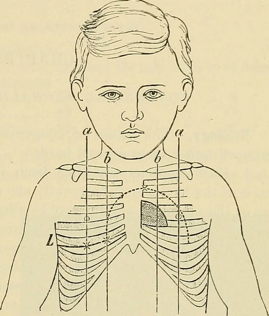 An illustration from The diseases of infancy and childhood : for the use of students and practitioners of medicine / by L. Emmett Holt with two hundred and forty-one illustrations, including eight coloured plates., 1908, leaf 651